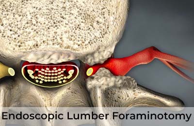 Endoscopic Lumber Foraminotomy