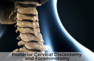 Posterior Cervical Discectomy and Foraminotomy