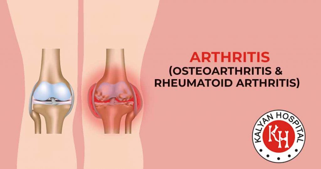 Arthritis (Osteoarthritis & Rheumatoid arthritis)