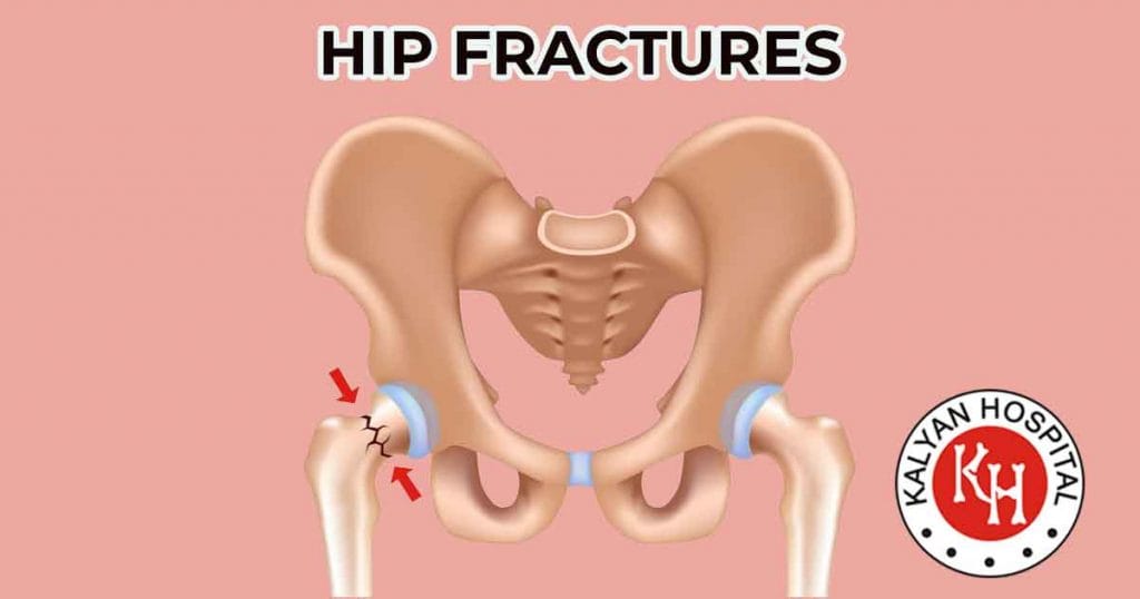 Hip Fractures