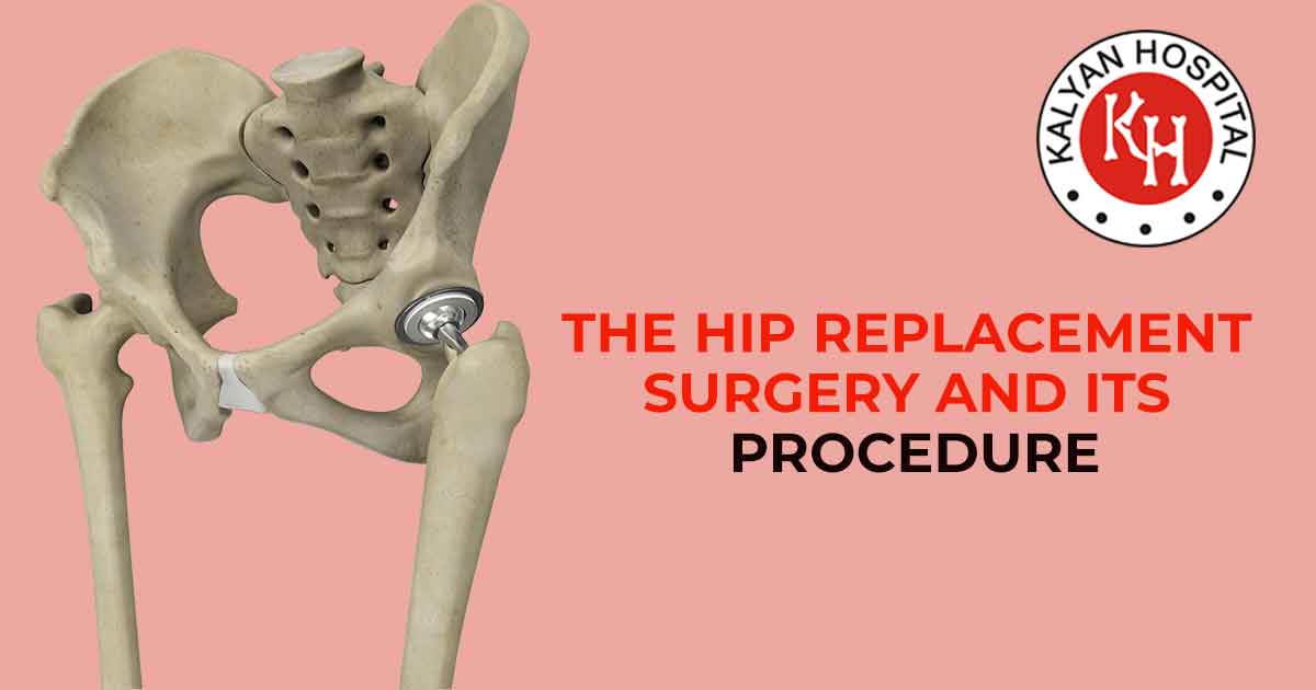 Hip Replacement: Facts That Entail This Surgical Option