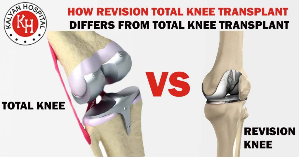 How revision total knee transplant differs from total knee transplant?
