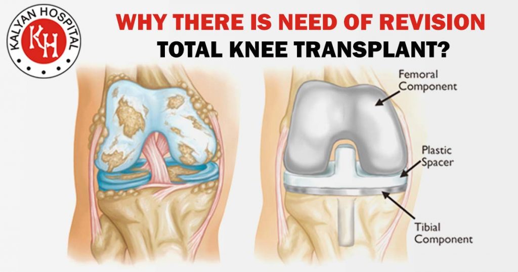 Why there is need of revision total knee transplant?