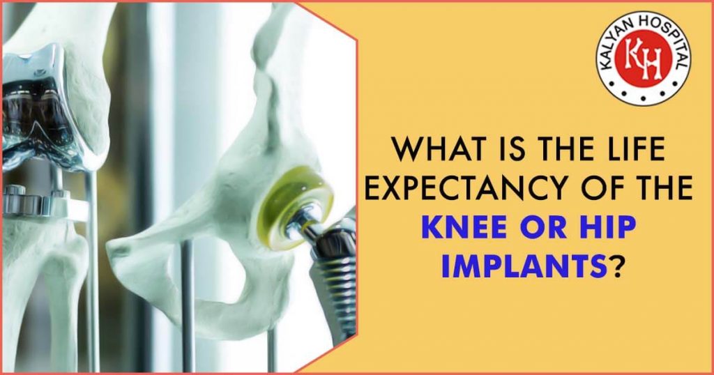 What Is The Life Expectancy Of The Knee Or Hip Implants?