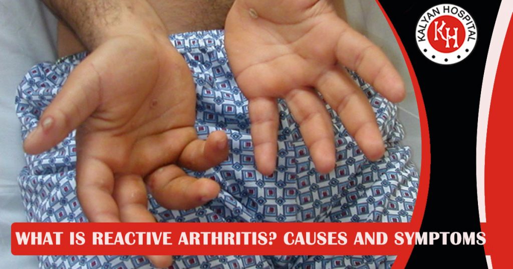 What is Reactive Arthritis Causes and Symptoms