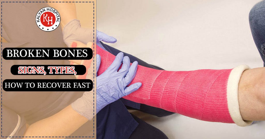 Broken Bones - Signs, Types, how to recover fast