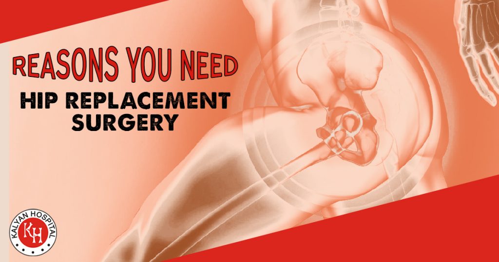 Reasons You Need Hip replacement Surgery