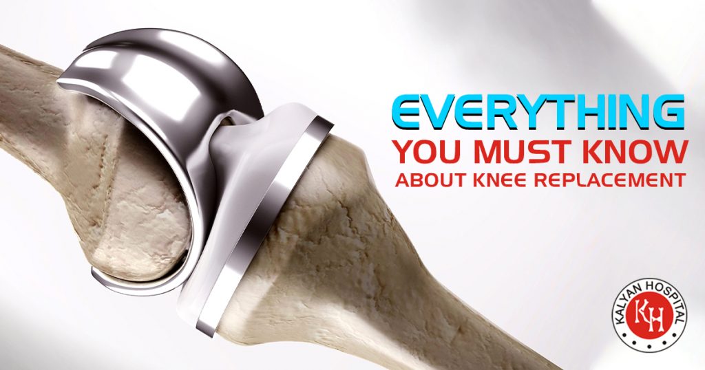 Everything You Must Know About Knee Replacement