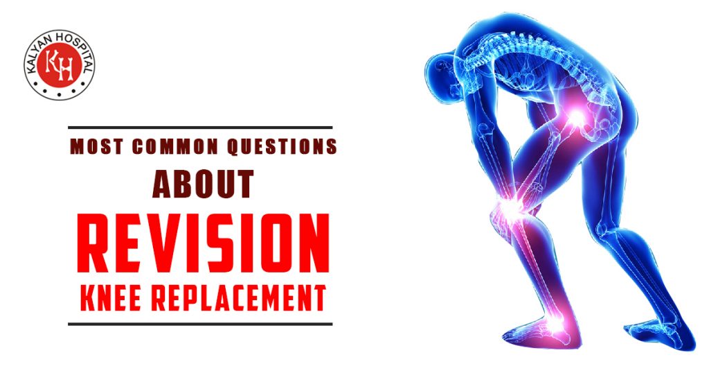 Most Common Questions About Revision Knee Replacement