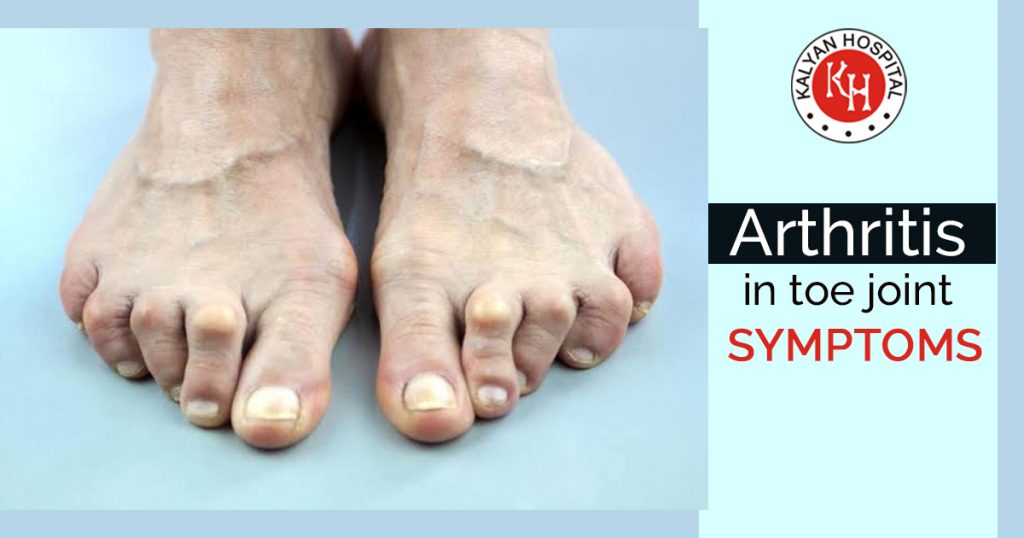 Arthritis in toe joint Symptoms