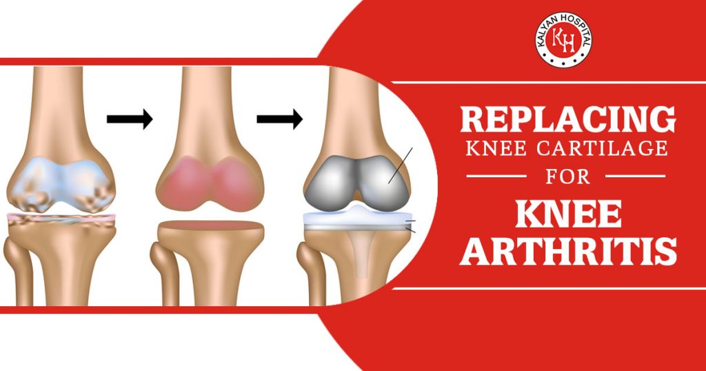 Replacing knee cartilage for knee arthritis