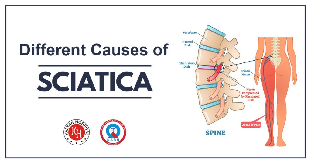 Different Causes of Sciatica